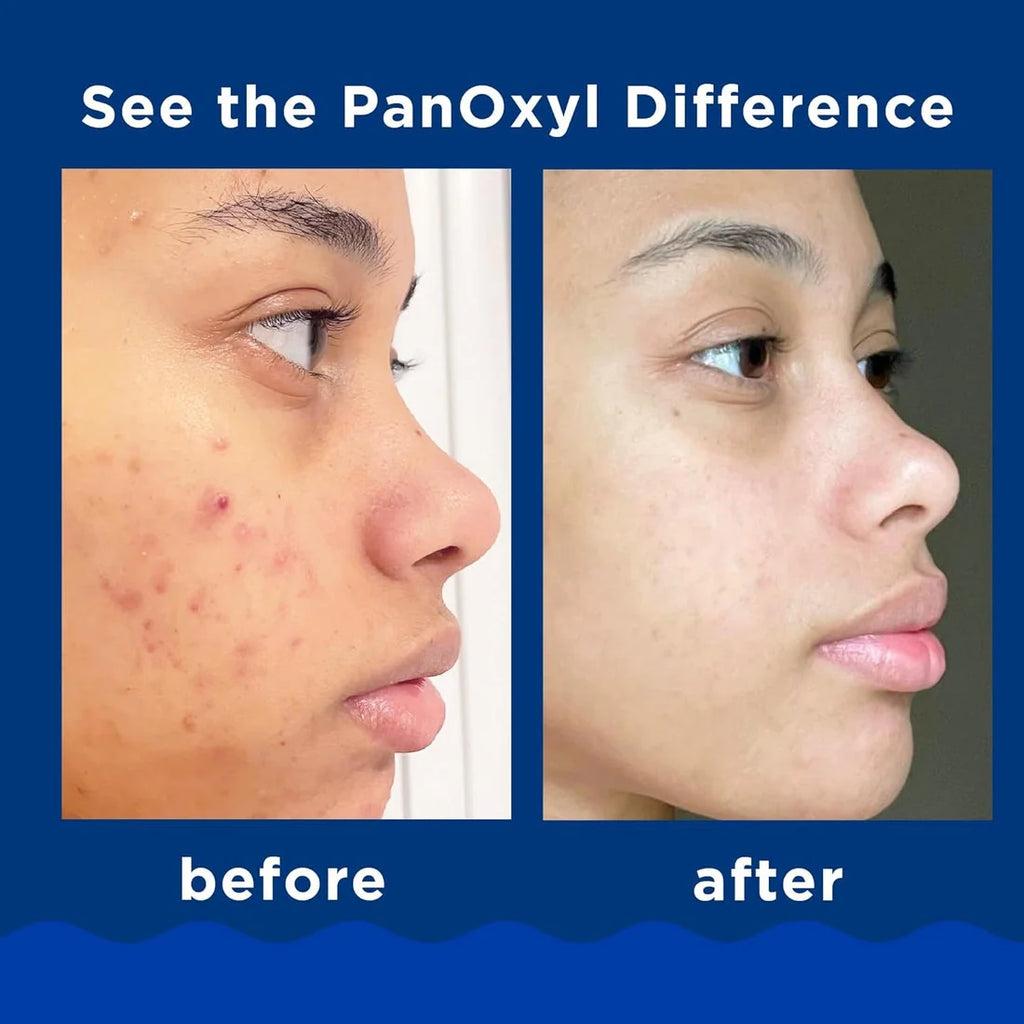 PanOxyl - Acne Foaming Wash
